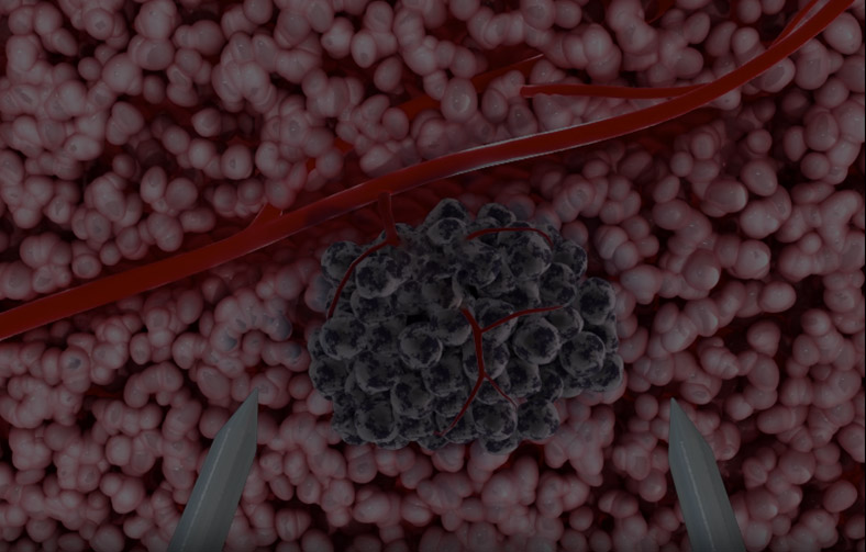 宽频陡脉冲肿瘤消融仪（<span>维纳刀</span>）