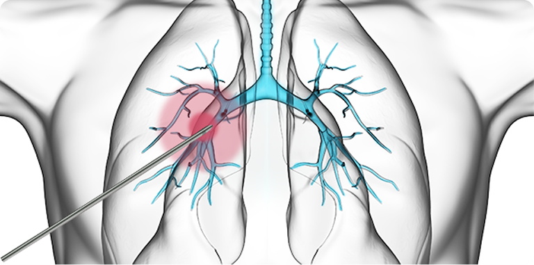 微创局麻 操作简单