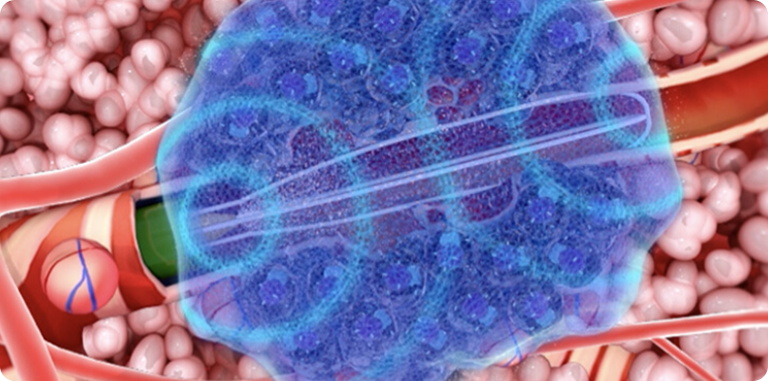 清除病灶，控制损伤